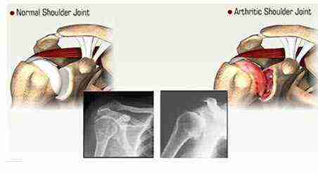 Normal Shoulder Joint and Arthritic Shoulder Joint