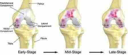 Meniscus Tear  : Early Stage, Mid-Stage, Late-Stage