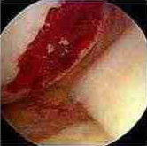 Operation to Stimulate Cartilage Growth (Area Clots)