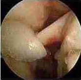 why rotator cuff injuries hurt (anterior impingment)